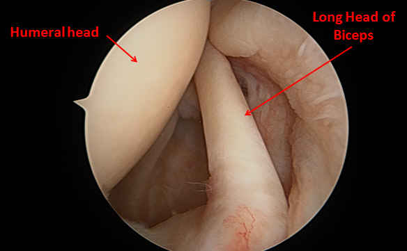 SLAP tear