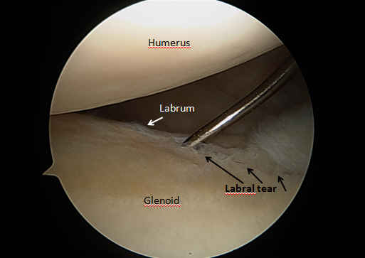 labrum tear