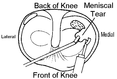 knee arthroscopy