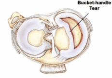 meniscus tear