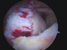 rotator cuff tear