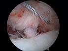 labrum tear