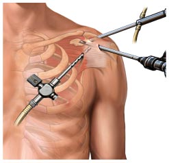 shoulder arthroscopy